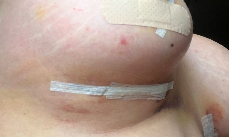 Si può alzare la protesi con fascia? - 70665