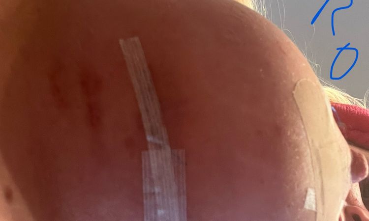 Si può alzare la protesi con fascia? - 70666