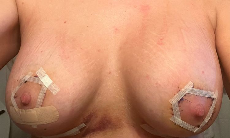 Si può alzare la protesi con fascia? - 70668
