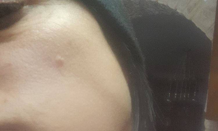 Dermatofibroma e successivo controllo - 71627
