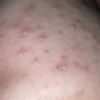 Peeling chimico per le macchie da acne