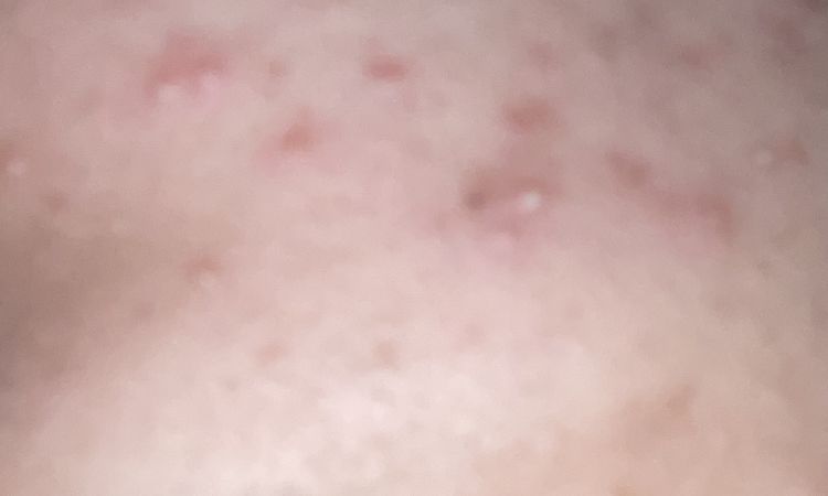 Peeling chimico per le macchie da acne - 71677