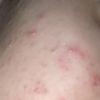 Peeling chimico per le macchie da acne