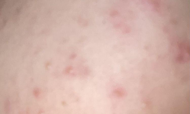 Peeling chimico per le macchie da acne - 71678