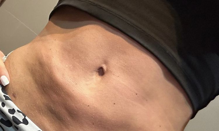 Problema post liposuzione - 72070