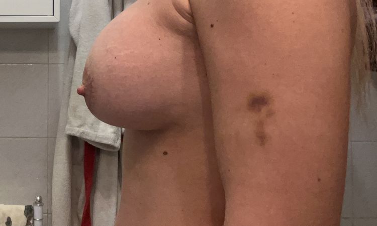 Riposizionamento protesi seno in ambulatorio? - 72136