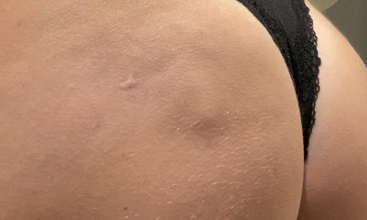 Glutei post trattamenti - 72166