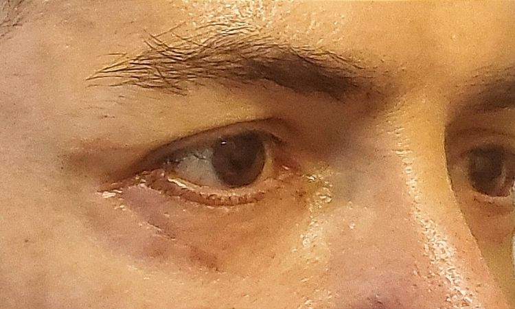 Post Blefaroplastica - Scleral Show e edema duro - 72455