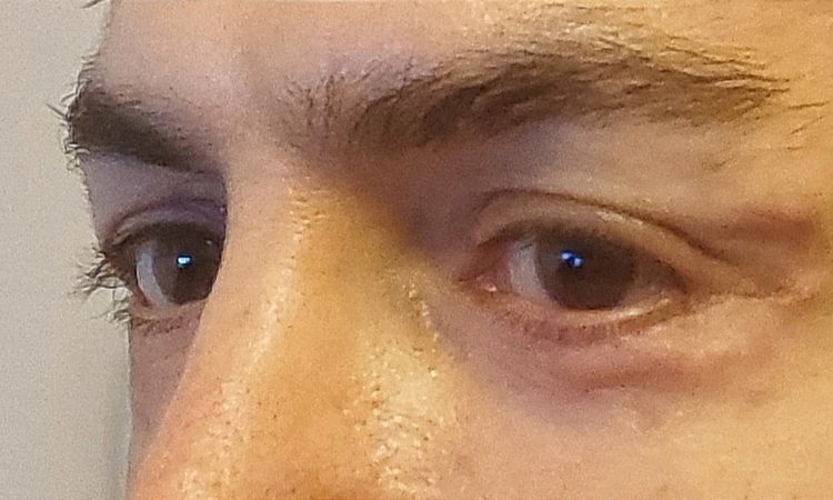 Post Blefaroplastica - Scleral Show e edema duro - 72458