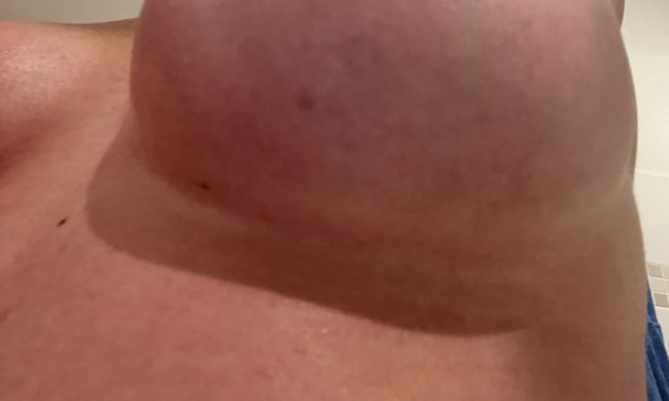 Si può fare qualcosa per seni post operazione mastoplastica - 72476