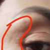 È possibile che il botox crei delle linee strane dopo il trattamento?
