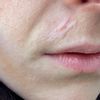 Labbra cheloide cicatrice