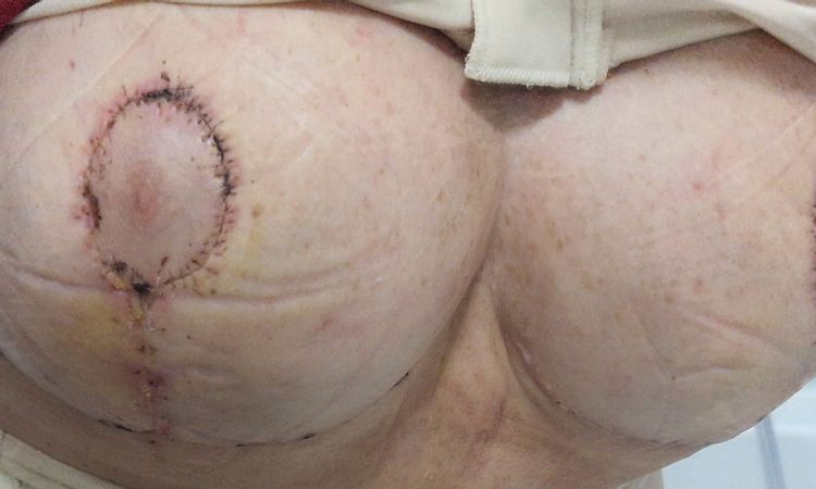 Mastopessi revisione a T - 72762