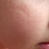 Cicatrice sul viso zona zigomo bambino 4 anni