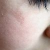 Cicatrice sul viso zona zigomo bambino 4 anni - 73024