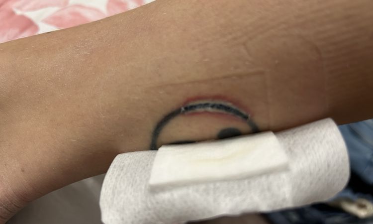 Ustione su tatuaggio dopo epilazione laser - 73036