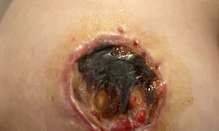 Necrosi areola/capezzolo - 73616