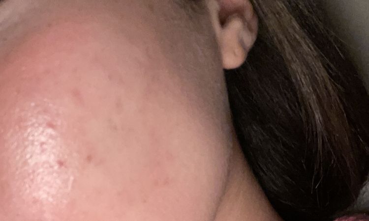 Macchie scure a seguito dell acne peggiorate dopo una terapia dermatologica - 73666