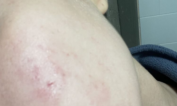 Macchie scure a seguito dell acne peggiorate dopo una terapia dermatologica - 73667