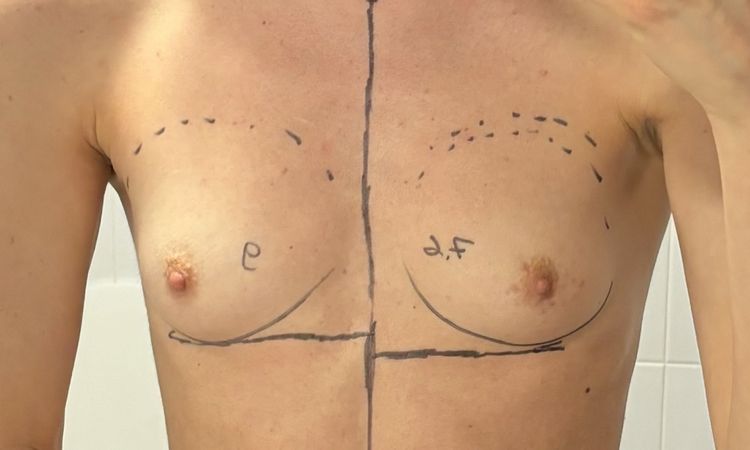 Seni diversi dopo un mese mastoplastica - 73818