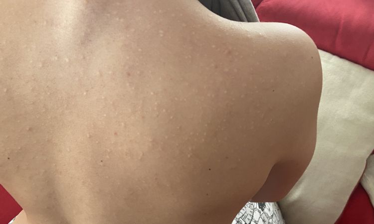 Cicatrici acne trattate con isotretinoina - 73863