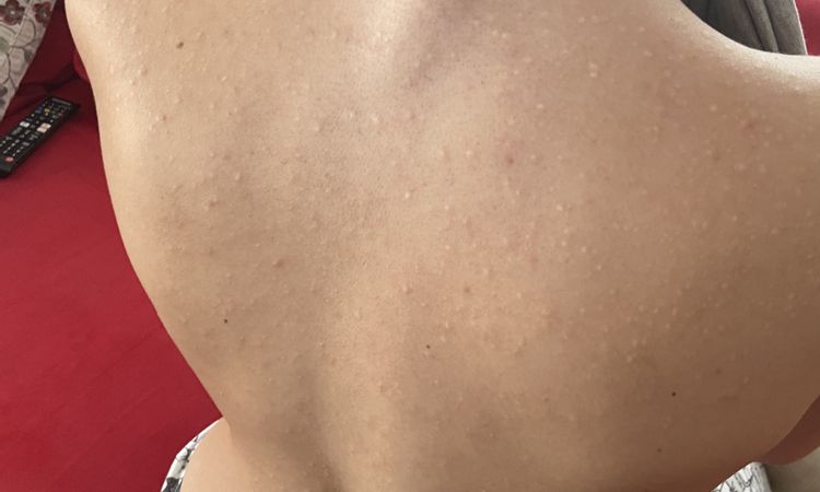 Cicatrici acne trattate con isotretinoina - 73864
