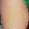 Lipoatrofia semicircolare gamba