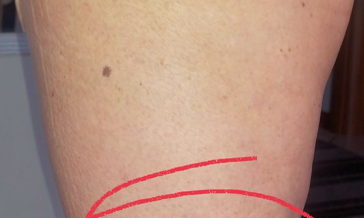 Lipoatrofia semicircolare gamba - 75036