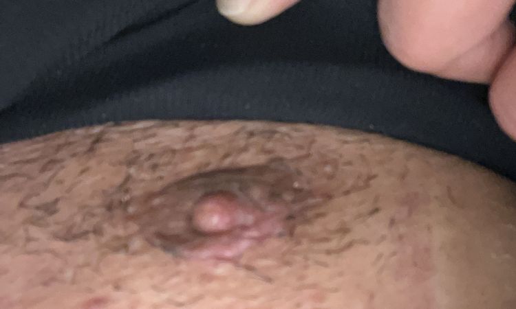 Ginecomastia cicatrici - 75118