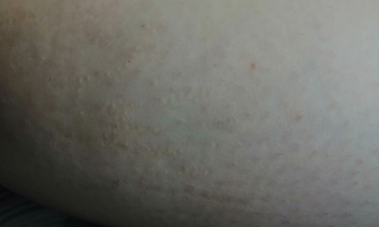 Macchie post laser smagliature - 75759