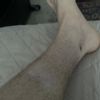 Lipoatrofia da cortisone