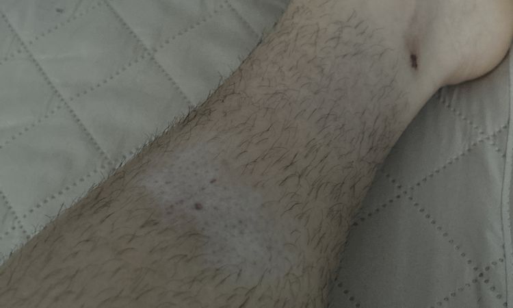 Lipoatrofia da cortisone - 75897