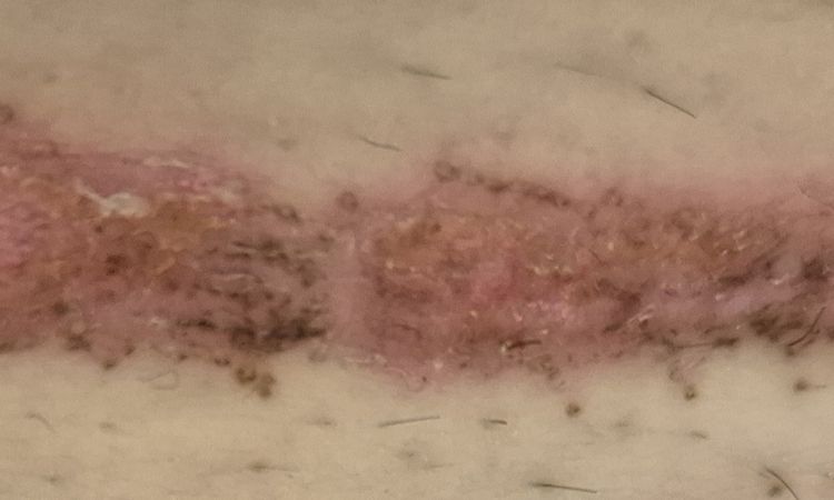 Laser co2 per trattamento cicatrice cesareo - 75944