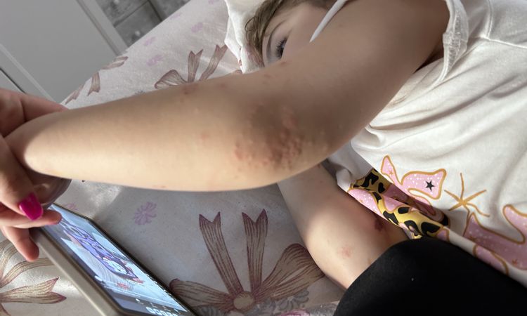 Cosa sono queste macchie sul corpo della mia bimba? - 75997