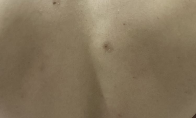 Macchie della pelle causate da laser alessandrite per asportazione nei - 76793
