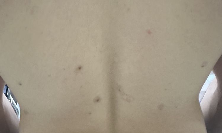 Macchie della pelle causate da laser alessandrite per asportazione nei - 76794