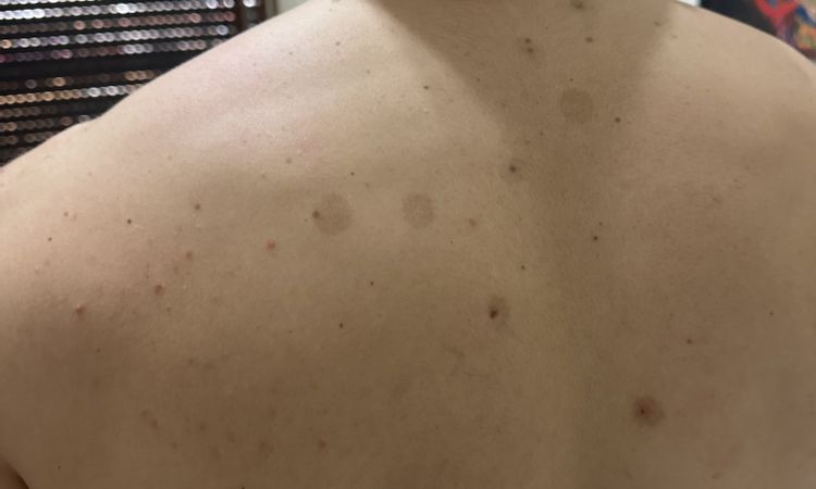 Macchie della pelle causate da laser alessandrite per asportazione nei - 76797