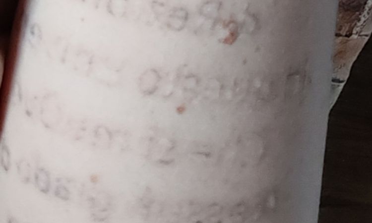 Iperpigmentazioni rimozione tatuaggi - 76880