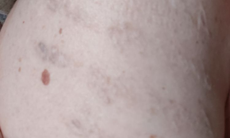 Iperpigmentazioni rimozione tatuaggi - 76881