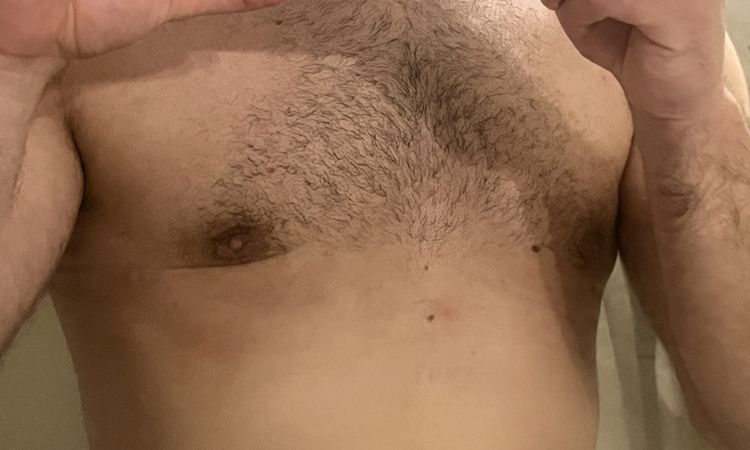Post operatorio ginecomastia 4 mesi - 76965