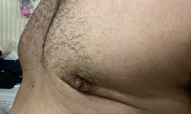 Post operatorio ginecomastia 4 mesi - 76967