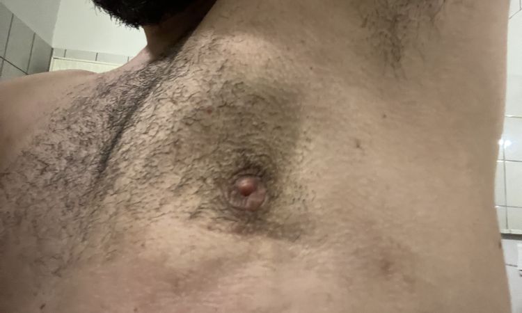 Post operatorio ginecomastia 4 mesi - 76968