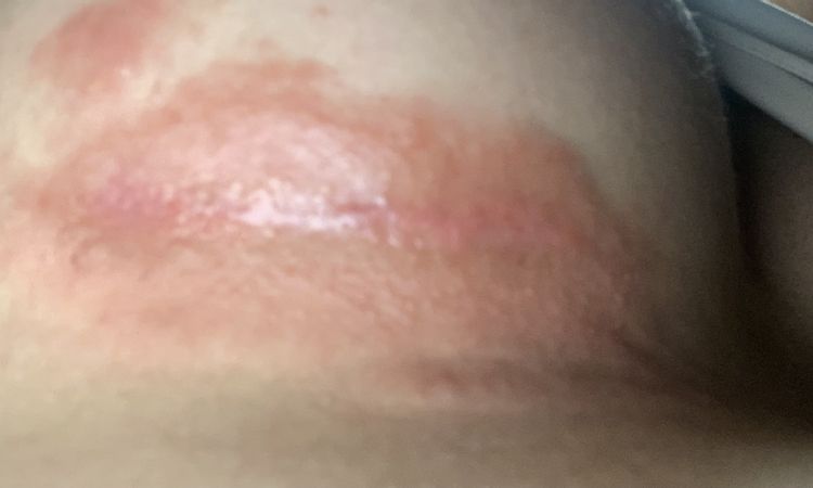 Cicatrice problematica post intervento seno - 77086