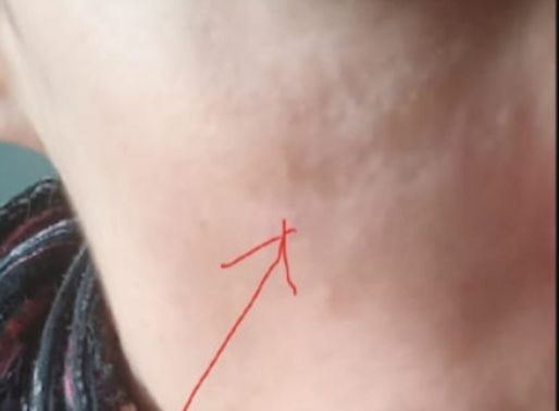 Gonfiore sottopalpebrale dopo due anni da filler - 77216
