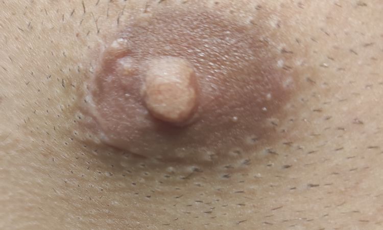 Recidiva cisti epidermoide capezzolo - 77253