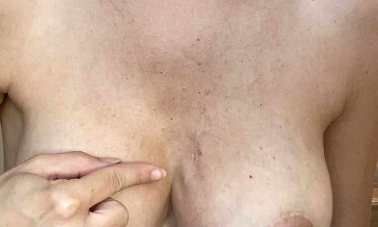 Cambio protesi sinistra? Meglio sotto muscolo? - 77681