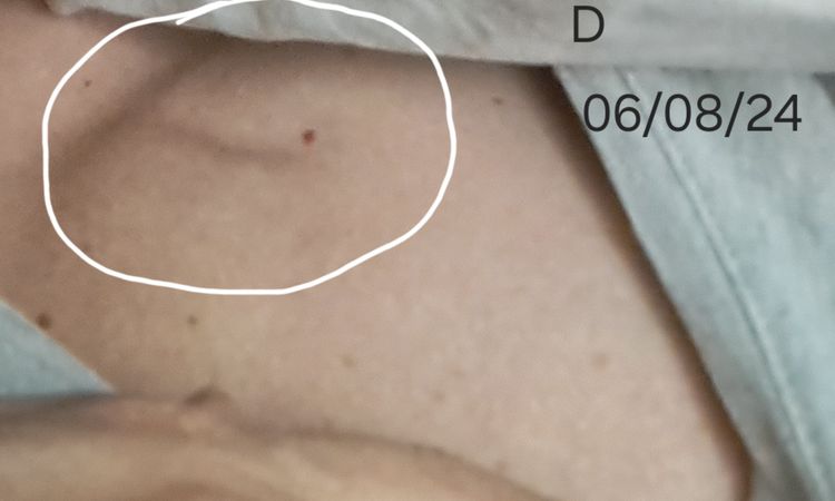 Mastopessi dopo un anno e possibile seconda contrattura? - 77914