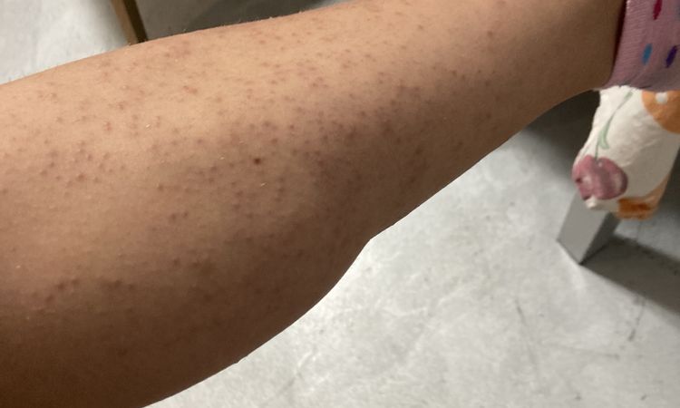 Follicolite/reazione istaminica dopo laser - 78668