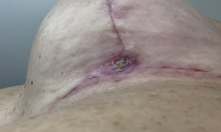 Cicatrici mastopessi infette? - 78681