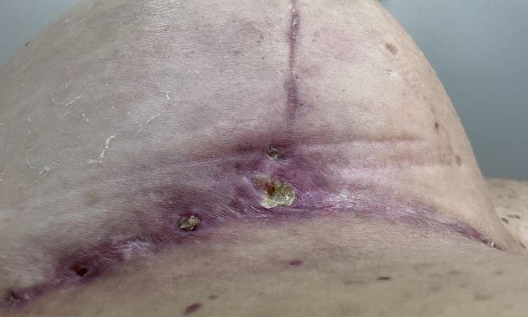 Cicatrici mastopessi infette? - 78682